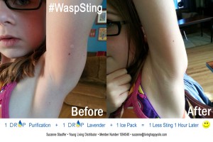 How To Treat Wasp Stings In Children Naturally